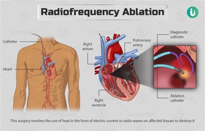 Can you have cardioversion after ablation?