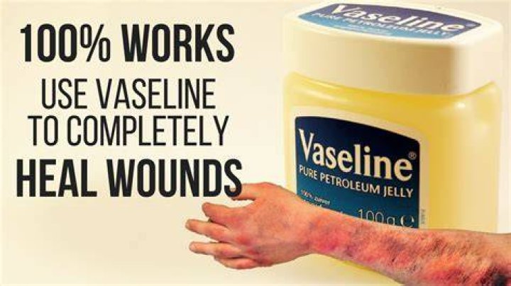 Can you put Vaseline on a burn?