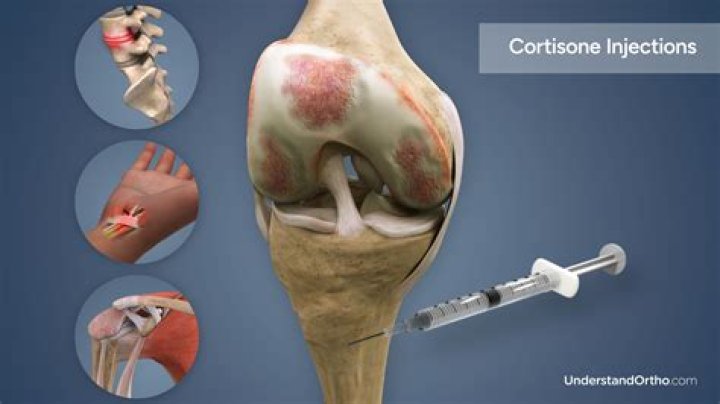 Do cortisone shots help avascular necrosis?