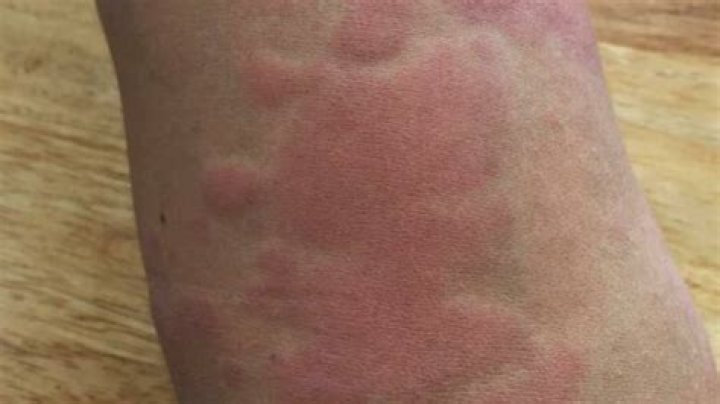 How can you tell if a rash is fungal or bacterial?