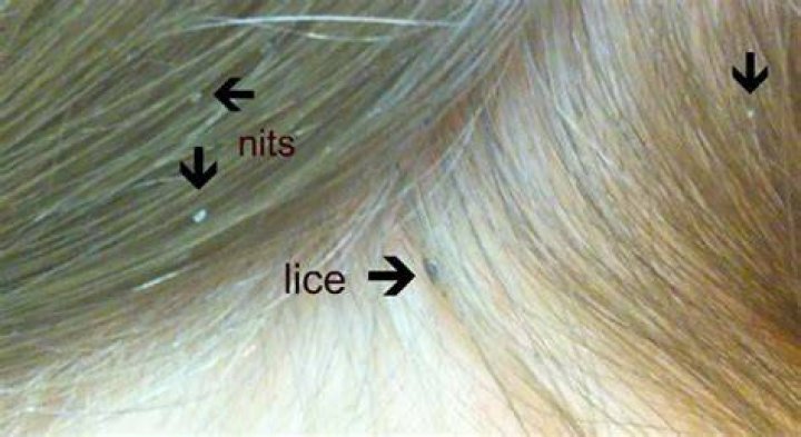 How do adults know if they have lice?