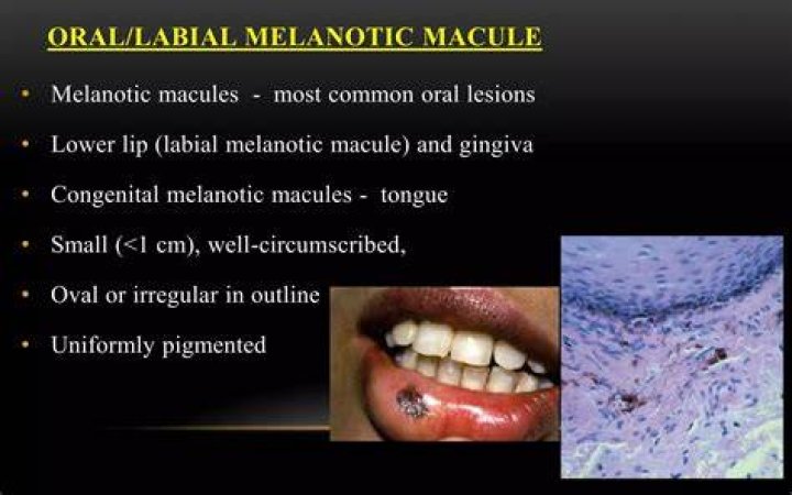 How do you get rid of Melanotic oral macule?