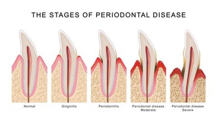 How long does gingivitis take to turn into periodontitis?