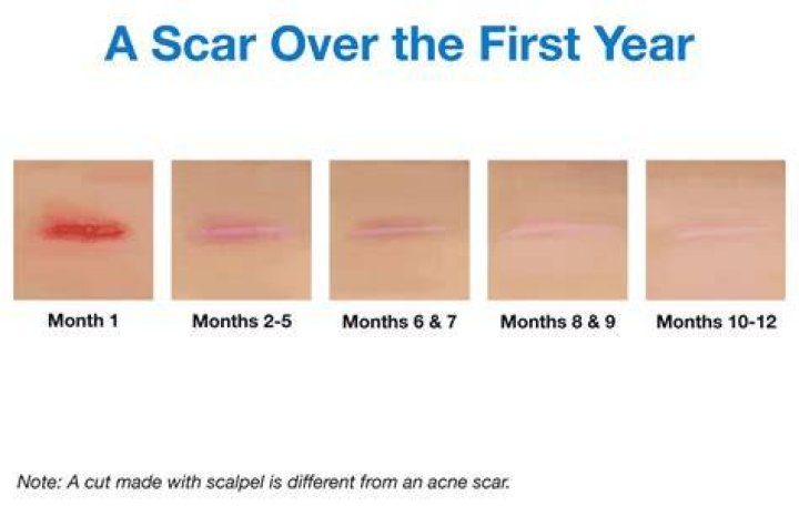 How long does it take redness on scars to go away?