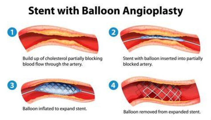 Should I get a stent or not?