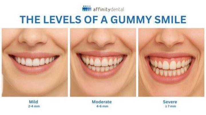 Should your gums show when you smile?