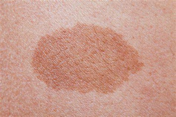 What does a pink birthmark mean?