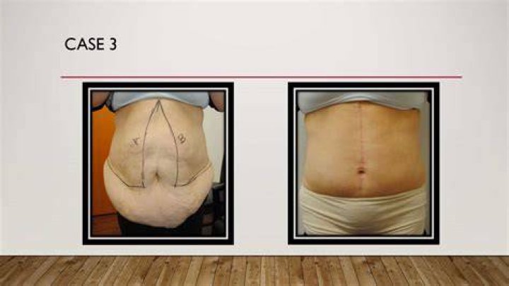 What happens to pubic area tummy tuck?