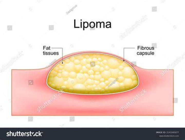 What is inside a lipoma?
